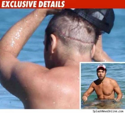 Jeremy Piven Hair Transplant.jpg
