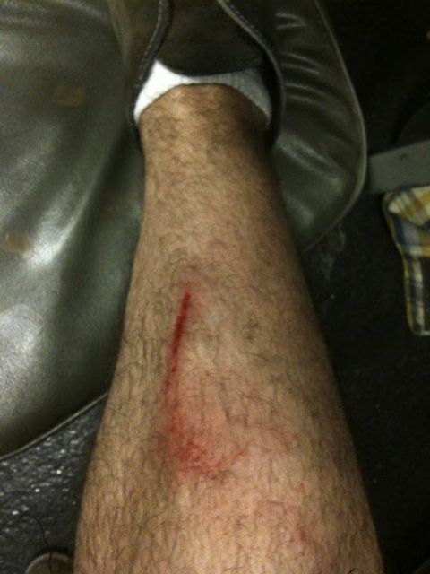 Kris Allen Injury.jpg