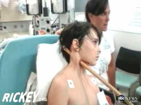 Boy Survives Bamboo Stick Through The Neck