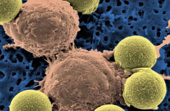Huge breakthrough in Cancer treatment using T cells