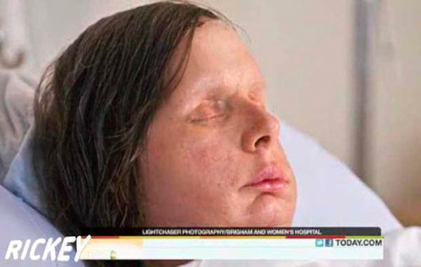 Woman nearly killed by chimp reveals new face