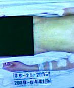 Michael Jackson Autopsy