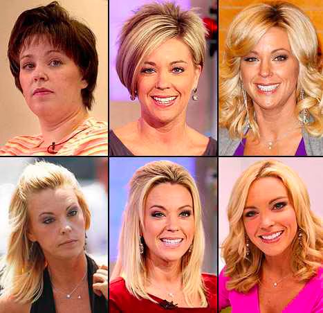 Kate Gosselin - Face Lift.jpg Kate Gosselin Face Lift