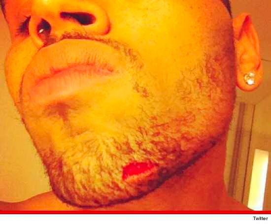 Chris Brown injured in fight with Drake entourage  Photo