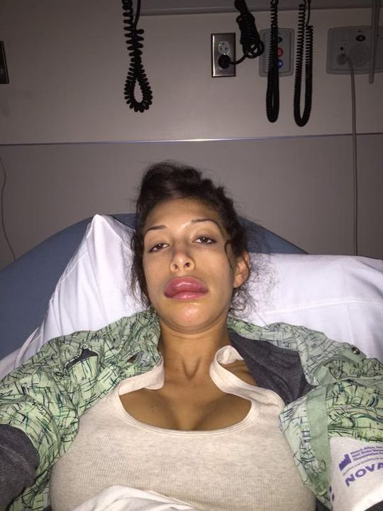 Farrah Abraham has HUGE lips now after botched surgery (PHOTO)