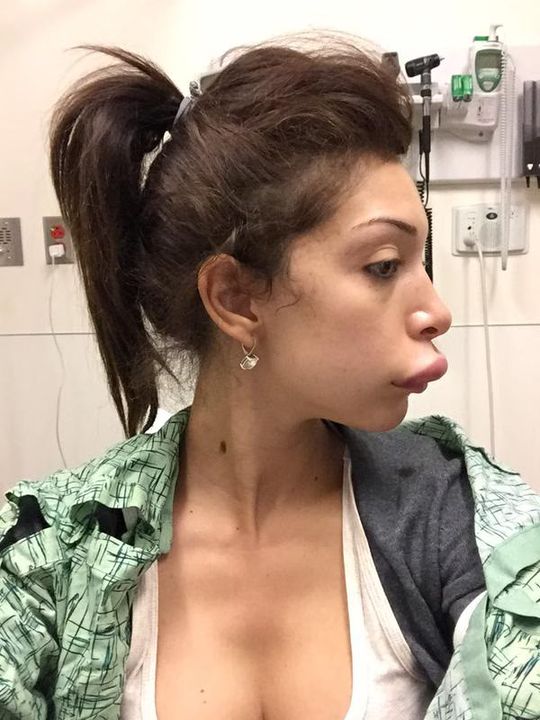 'Teen Mom' Farrah Abraham has HUGE lips now after botched surgery (PHOTO)