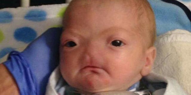 Baby Born Without A Nose Is Finally Home PHOTO VIDEO