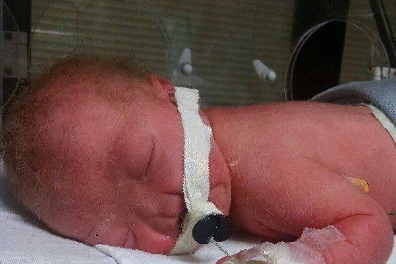 Baby Born Without A Nose Is Finally Home