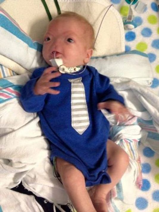 Baby Born Without A Nose