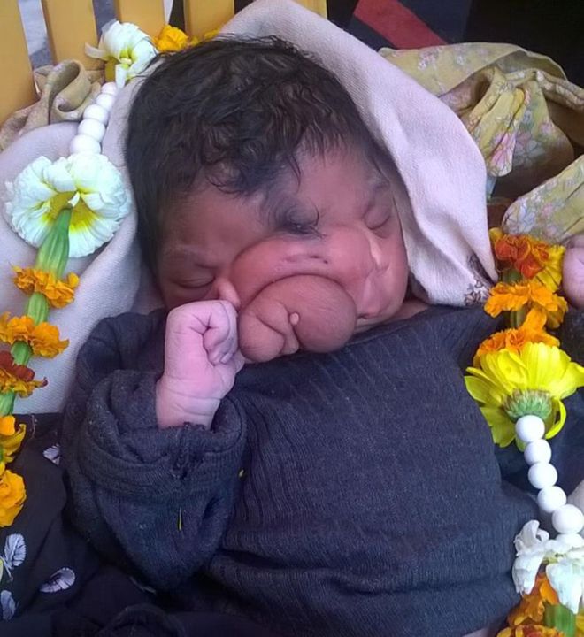 Baby Born With 'Elephant Trunk' Nose Worshipped Like A God In India (PHOTO, VIDEO)